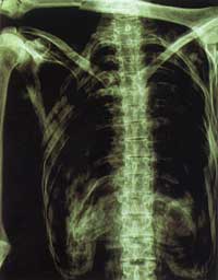 Xray of Iceman